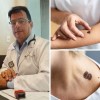 Oncologista  da Santa Casa de Araçatuba alerta: Moradores do interior devem tomar ainda mais cuidado com câncer de pele
