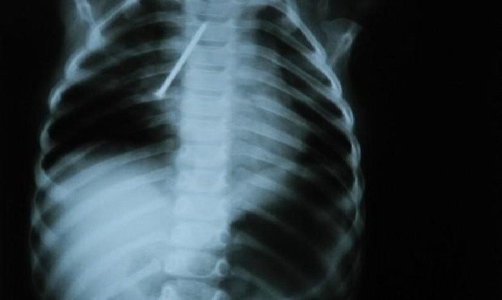 Bebê de 11 meses é resgatado engasgando após engolir prego em Três Lagoas
