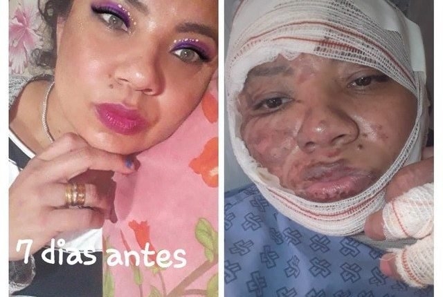 Chapa explode, provoca queimaduras em cantor sertanejo e mais duas pessoas em Três Lagoas