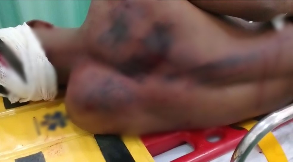 Adolescente de 17 anos é espancado por padrasto com pedaço de madeira ao entrar em briga para defender mãe